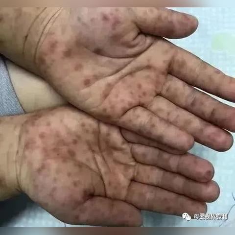 最新病毒感染什么症状（人体病毒感染有什么症状）