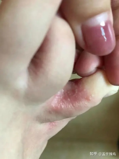 脚上起小水泡很痒是怎么回事（怀孕脚上起小水泡很痒是怎么回事）